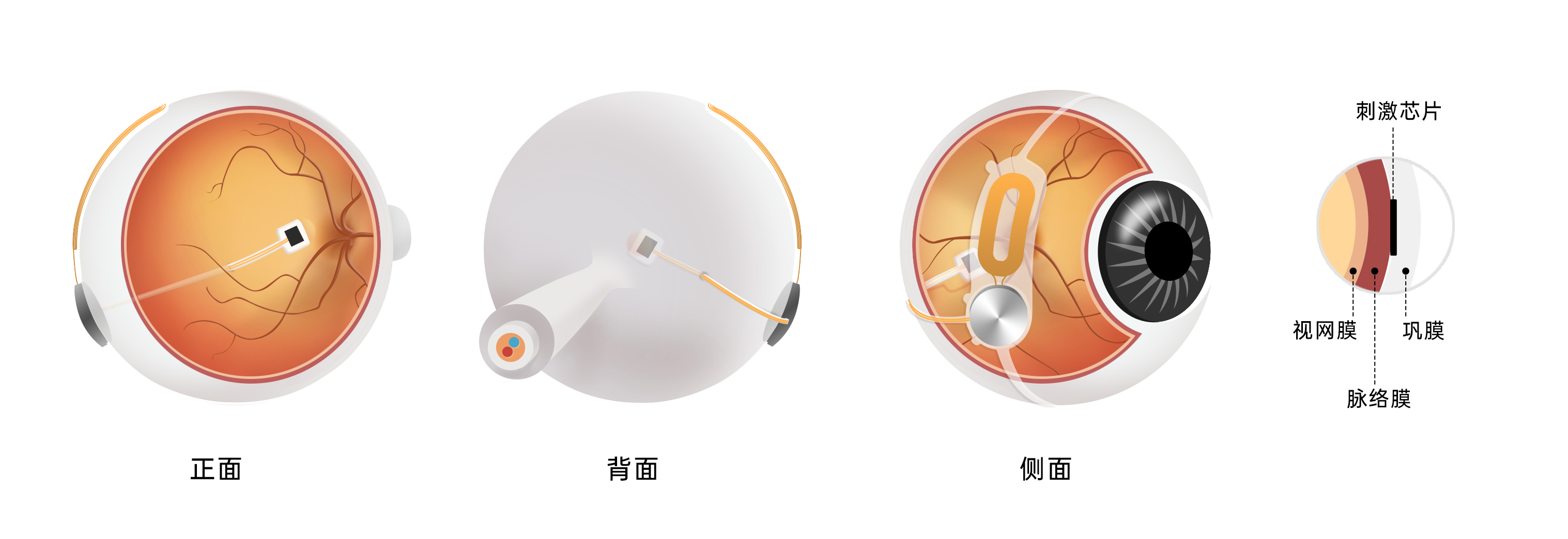 全国首例黄斑区脉络膜下视网膜脑机接口手术成功